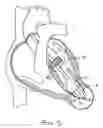Fig. 04 - Methods and devices for altering blood flow through the left ventricle