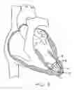Fig. 06 - Methods and devices for altering blood flow through the left ventricle