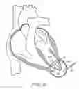 Fig. 07 - Methods and devices for altering blood flow through the left ventricle