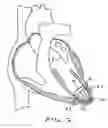 Fig. 08 - Methods and devices for altering blood flow through the left ventricle