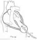 Fig. 09 - Methods and devices for altering blood flow through the left ventricle
