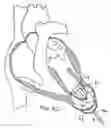 Fig. 22 - Methods and devices for altering blood flow through the left ventricle