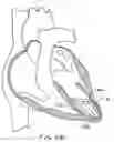 Fig. 28 - Methods and devices for altering blood flow through the left ventricle