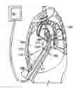 Fig. 01 - Diaphragm entry for posterior surgical access