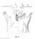 Fig. 03 - Oval-Shaped Cardiac Cannula