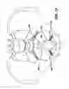 Fig. 09 - Adjustable vaginal splint for pelvic floor support
