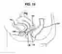 Fig. 11 - Adjustable vaginal splint for pelvic floor support