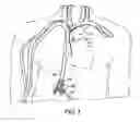 Fig. 02 - Methods for Using Adipose-Derived Cells for Healing of Aortic Aneurysmal Tissue