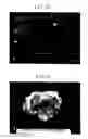 Fig. 11 - Apparatus and method for delivering ablative laser energy and determining the volume of tumor mass destroyed