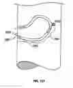 Fig. 69 - Method and apparatus for body fluid sampling and analyte sensing