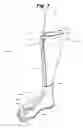 Fig. 02 - Device for treating foot drop