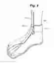 Fig. 05 - Device for treating foot drop