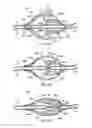 Fig. 08 - Apparatus and methods for clearing obstructions from surgical cutting instruments