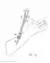 Fig. 09 - Safety catheter system and method