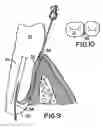Fig. 04 - Device for targeted, catherized delivery of medications