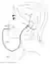Fig. 01 - Ear fluid removal device
