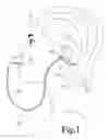 Fig. 02 - Ear fluid removal device