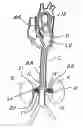 Fig. 01 - APPARATUS AND METHODS FOR TREATING CONGESTIVE HEART DISEASE