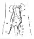Fig. 01 - Method for treatment of varices