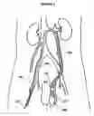 Fig. 02 - Method for treatment of varices