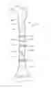 Fig. 01 - System for intramedullary rod fixation and method therefor