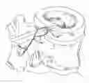 Fig. 01 - Apparatus and methods for the treatment of the intervertebral disc