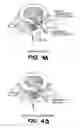 Fig. 04 - Apparatus and methods for the treatment of the intervertebral disc