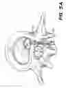 Fig. 05 - Apparatus and methods for the treatment of the intervertebral disc