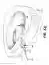 Fig. 08 - Apparatus and methods for the treatment of the intervertebral disc