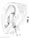Fig. 11 - Apparatus and methods for the treatment of the intervertebral disc