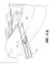 Fig. 16 - Apparatus and methods for the treatment of the intervertebral disc