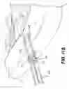 Fig. 17 - Apparatus and methods for the treatment of the intervertebral disc