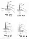 Fig. 34 - Apparatus and methods for the treatment of the intervertebral disc