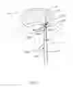 Fig. 52 - Apparatus and methods for the treatment of the intervertebral disc