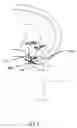 Fig. 61 - Apparatus and methods for the treatment of the intervertebral disc