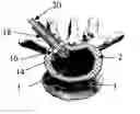 Fig. 01 - Nucleus augmentation delivery device and technique
