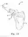 Fig. 22 - Multiple suture anchor delivery device, suture anchor delivery kit and associated method