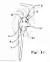 Fig. 23 - Multiple suture anchor delivery device, suture anchor delivery kit and associated method