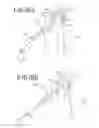 Fig. 15 - Method of arthroscopic or open rotator cuff repair using an insertional guide for delivering a suture pin
