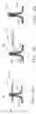 Fig. 42 - Surgical repair kit and its method of use