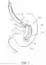 Fig. 02 - Intragastric space filler