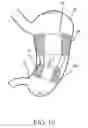 Fig. 11 - Intragastric space filler