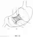 Fig. 14 - Intragastric space filler