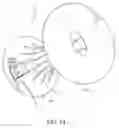Fig. 15 - Intragastric space filler
