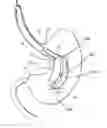 Fig. 01 - Intragastric space filler
