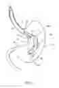 Fig. 02 - Intragastric space filler