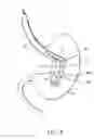 Fig. 05 - Intragastric space filler