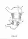 Fig. 11 - Intragastric space filler