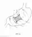 Fig. 14 - Intragastric space filler