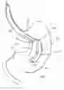 Fig. 01 - Intragastric space filler